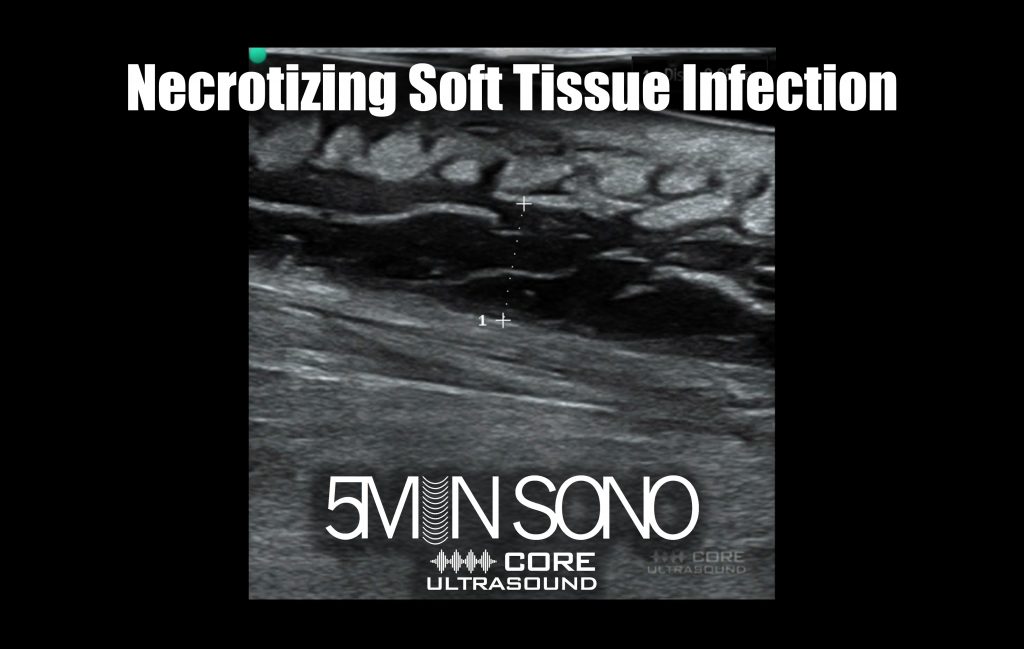 Necrotizing Soft Tissue Infections Core Ultrasound