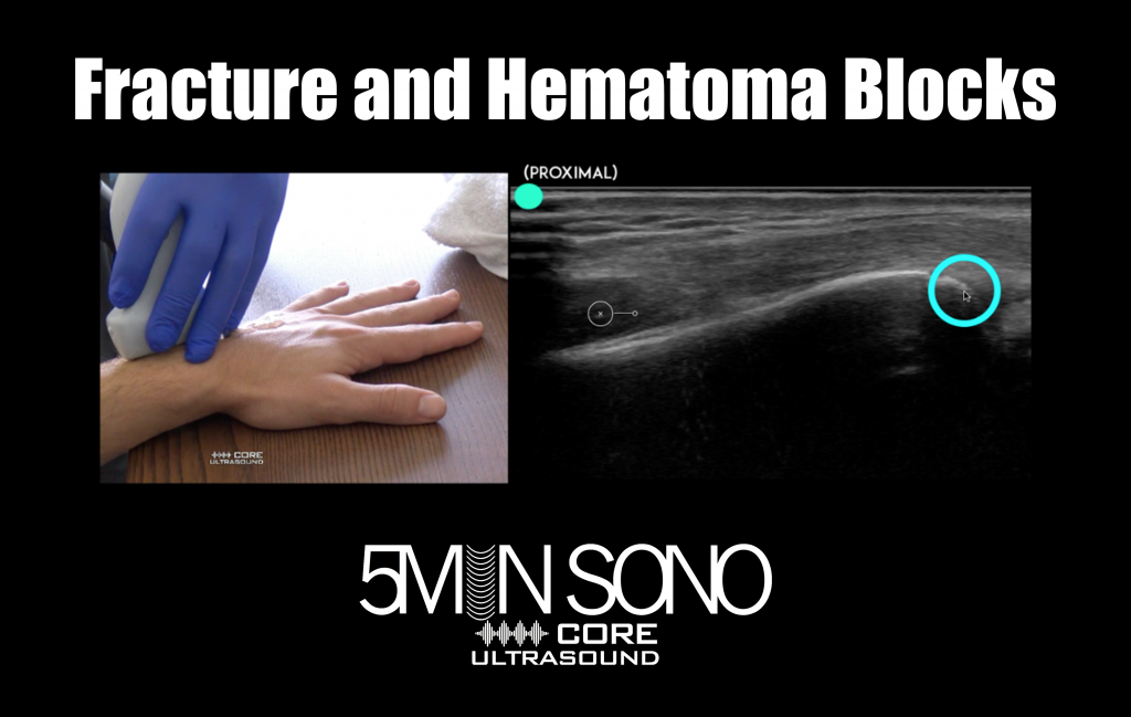 Fracture Identification And Hematoma Blocks Core Ultrasound