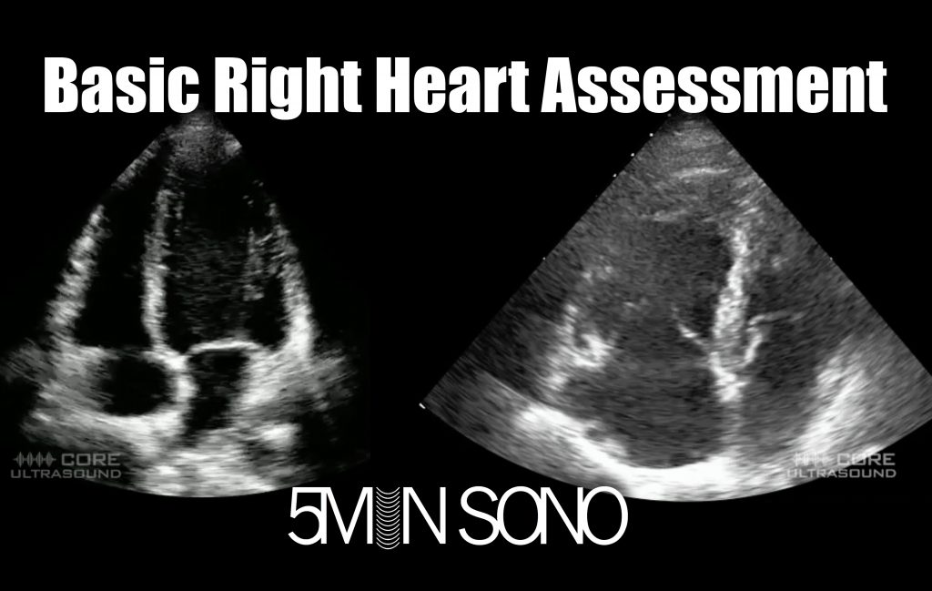 Right Heart Strain – Core Ultrasound