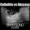 Cellulitis versus abscess - 5minsono