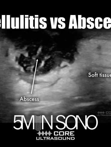 Cellulitis versus abscess - 5minsono