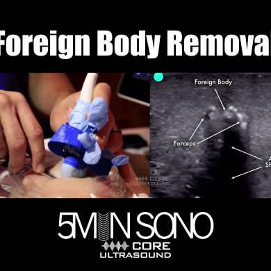 Foreign body removal - 5minsono