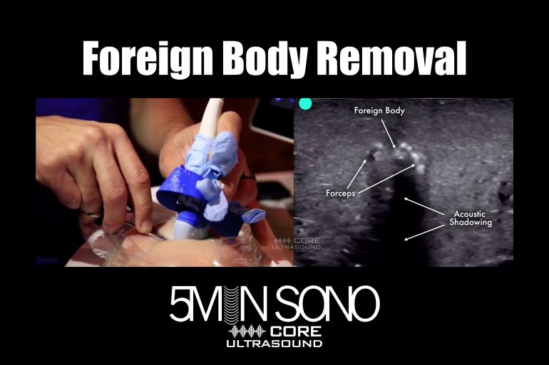 Foreign body removal - 5minsono