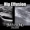 Hip effusion - 5minsono
