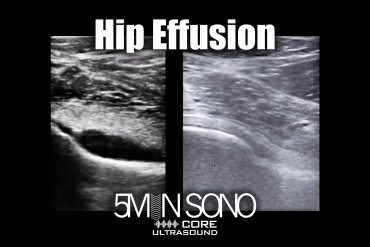 Hip effusion - 5minsono