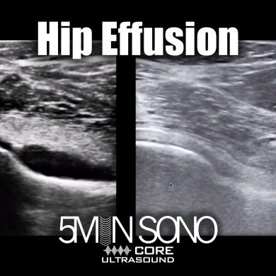 Hip effusion - 5minsono