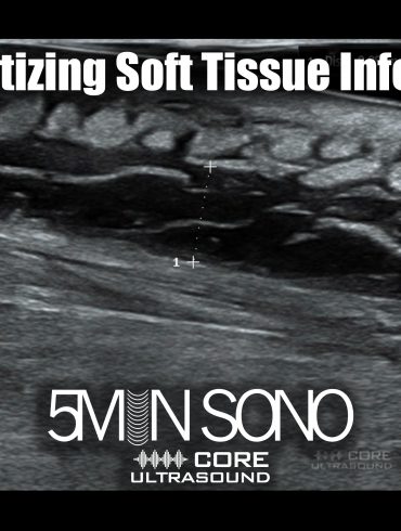 Necrotizing soft tissue infection - 5minsono