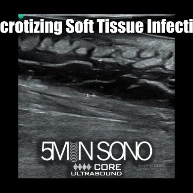 Necrotizing soft tissue infection - 5minsono