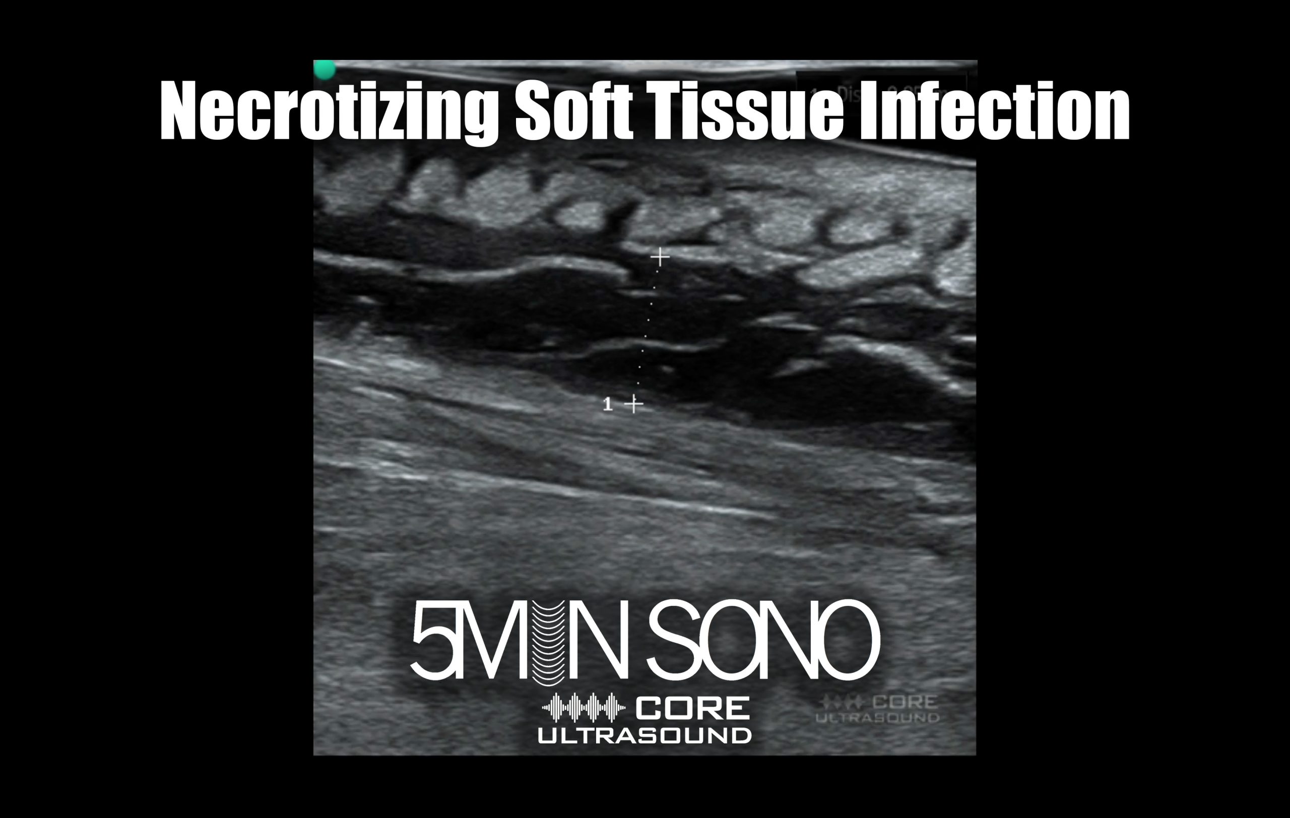 Ultrasound Diagnosis of Necrotizing Soft Tissue Infections – Core EM