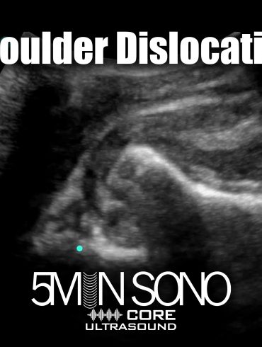 Shoulder dislocation – 5minsono