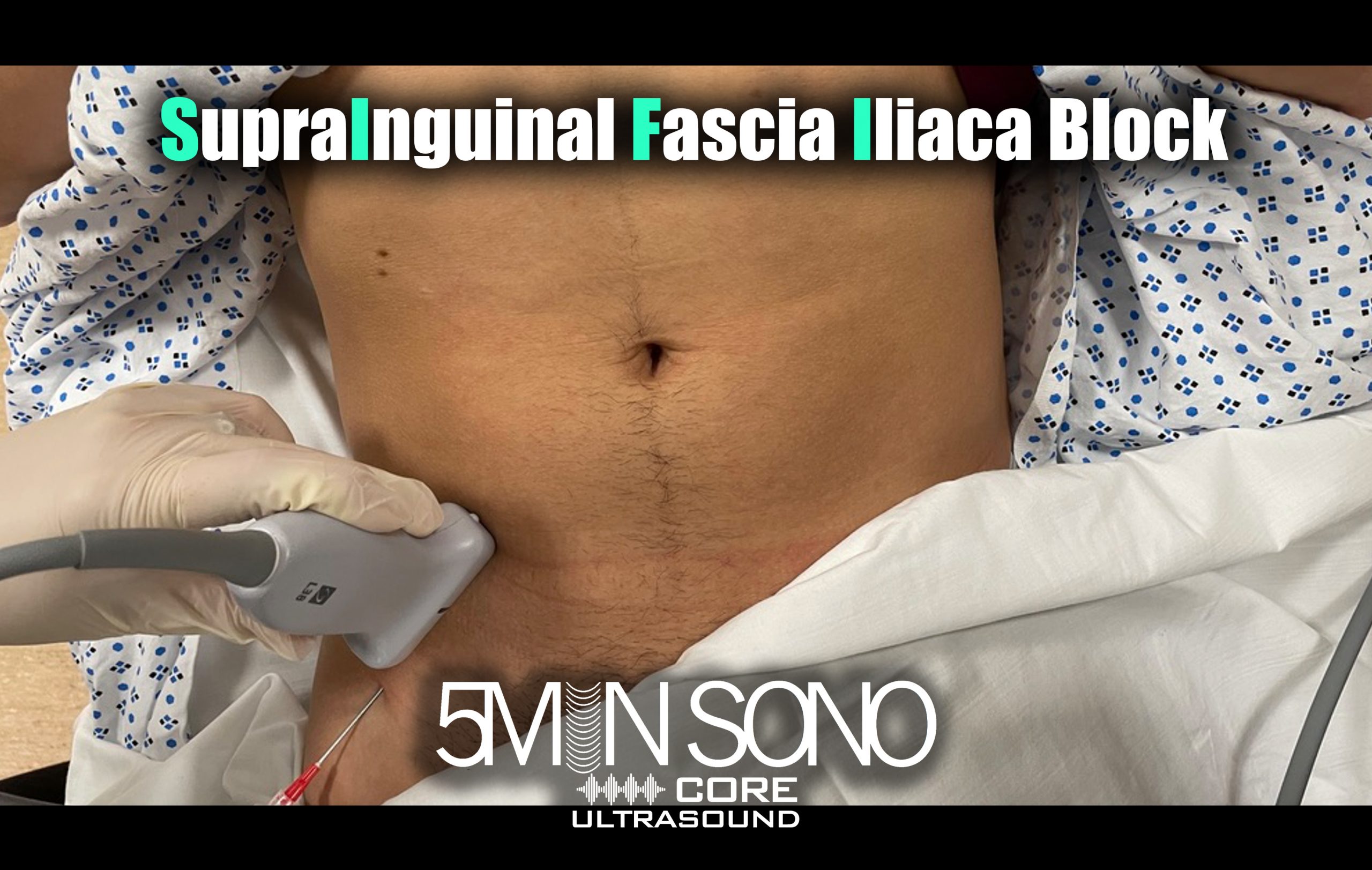 5 Minute Sono – Suprainguinal Fascia Iliaca Block - Core Ultrasound