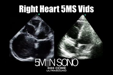 Right heart - 5minsono