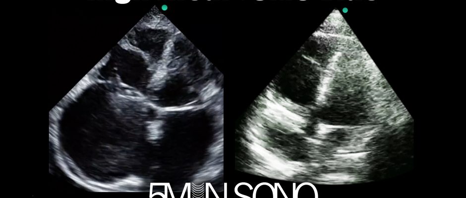 Right heart - 5minsono