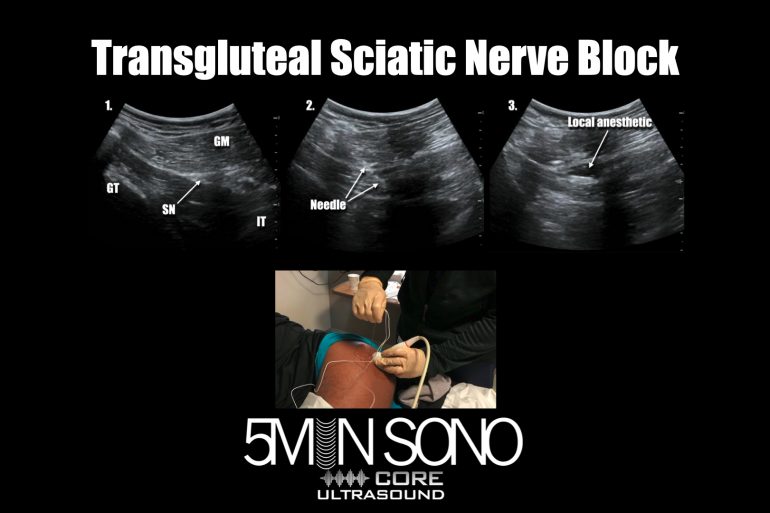 Nerve blocks - Core Ultrasound