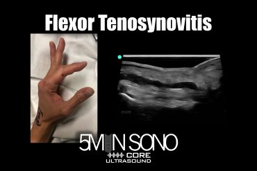 Flexor tenosynovitis - 5minsono