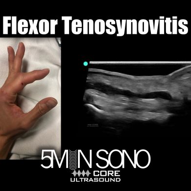 Flexor tenosynovitis - 5minsono