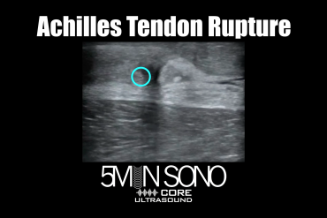 Achilles Tendon Rupture - 5minsono