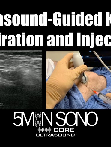 Ultrasound Guided Knee injections and Aspirations - 5minsono