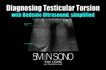 Diagnosing Testicular Torsion with bedside ultrasound, simplified