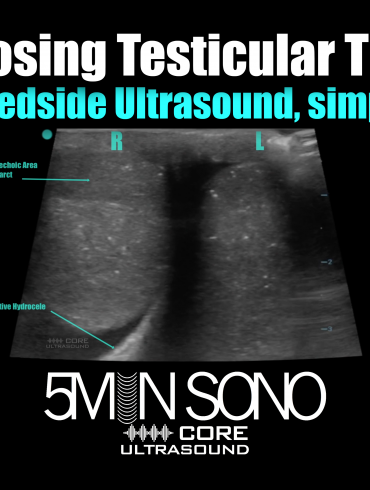 Diagnosing Testicular Torsion with bedside ultrasound, simplified