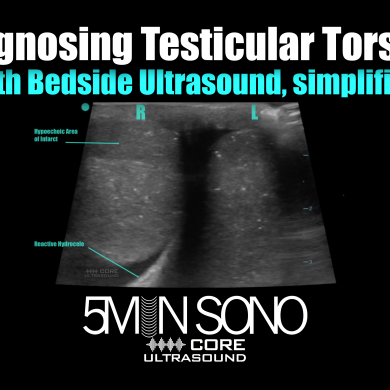 Diagnosing Testicular Torsion with bedside ultrasound, simplified