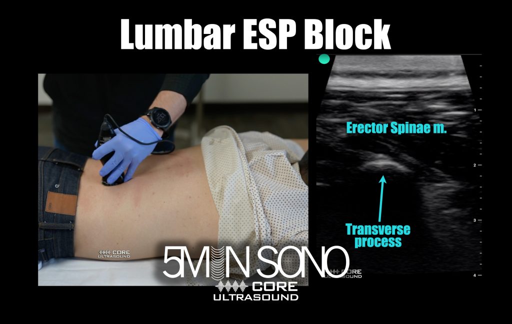 lumbar-erector-spine-plane-block-core-ultrasound