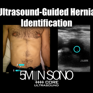 Ultrasound Guided Hernia Identification