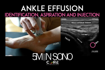 Ankle Ultrasound - Aspiration and injection - Core Ultrasound