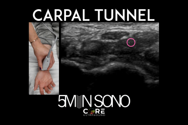 Carpal Tunnel Exam - Core Ultrasound