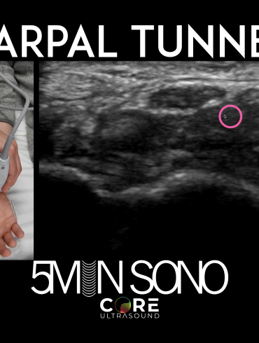 Carpal Tunnel Exam - Core Ultrasound