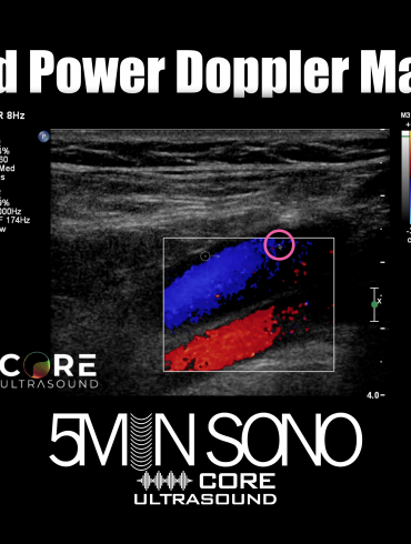 Pulsed Wave and Continuous Wave Doppler