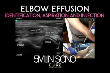 Elbow Ultrasound - Aspiration and injection - Core Ultrasound