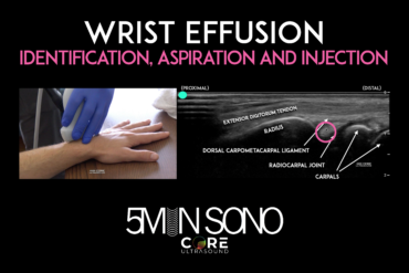 Wrist Ultrasound - Aspiration and injection - Core Ultrasound