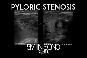 Pyloric Stenosis Core Ultrasound